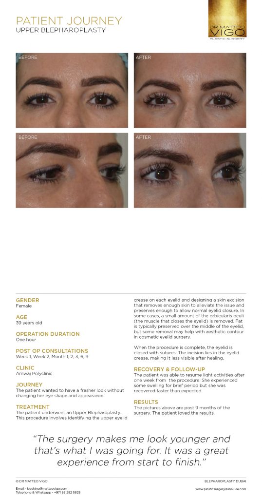 UPPER BLEPHAROPLASTY