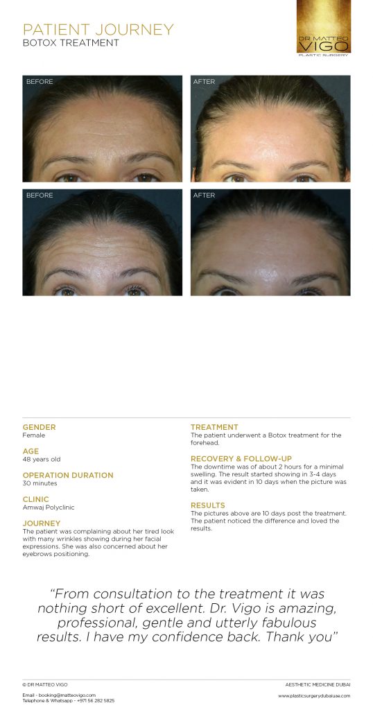 BOTOX TREATMENT