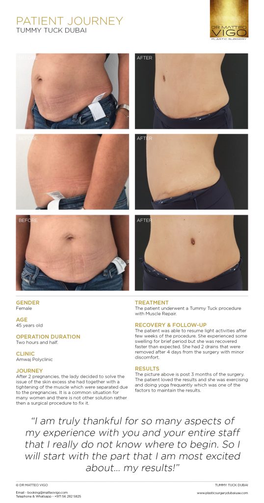 TUMMY TUCK