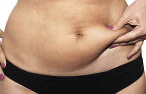 Abdominoplasty Dubai