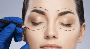 Blepharoplasty Dubai