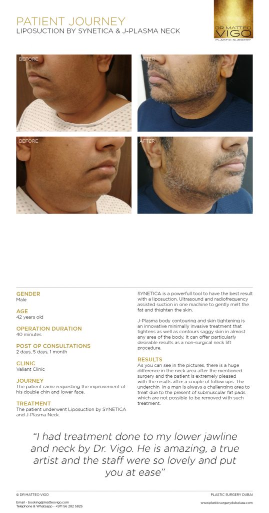 LIPOSUCTION BY SYNETICA & J-PLASMA NECK