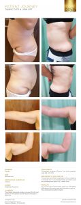 Tummy Tuck Dubai