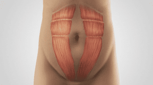 Abdominoplasty Dubai