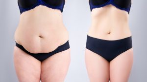 Abdominoplasty Dubai