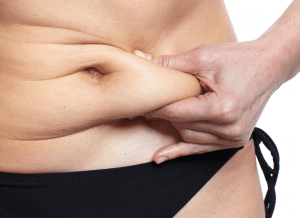 Abdominoplasty Dubai