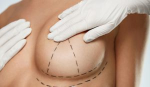 Breast Augmentation Dubai