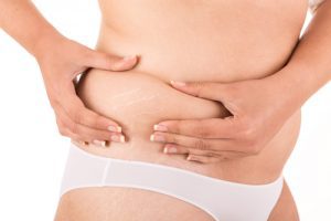 Tummy tuck Dubai