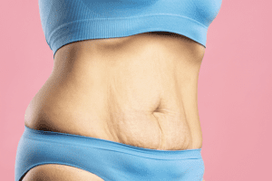 Tummy Tuck Dubai