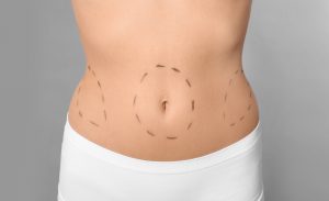 Tummy Tuck Dubai