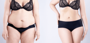 Tummy Tuck Dubai