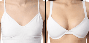 Breast Augmentation Dubai